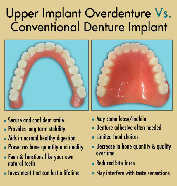 Dental Implants Sujay's Dental Care