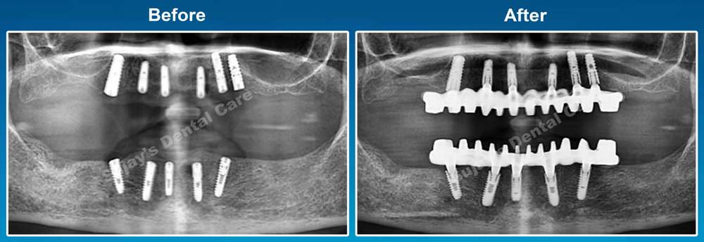 before-and-after-image-dental-implants-case-story-8