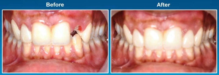 Before and After Image Dental Implants Case