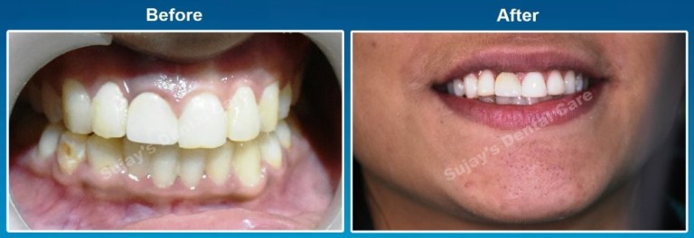 Before and After Image Teeth Whitening