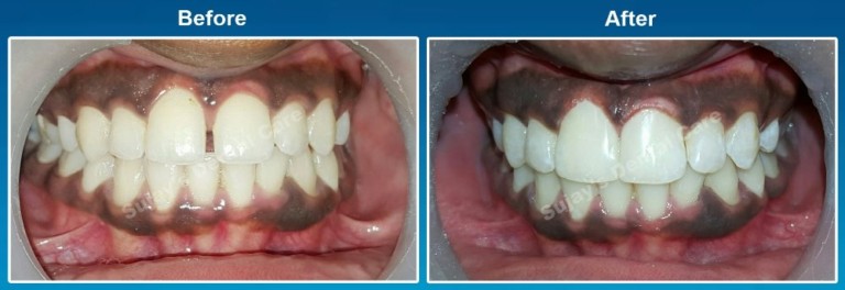 Before and after Image Midline Diastema