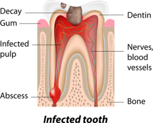 Infected Tooth diagram