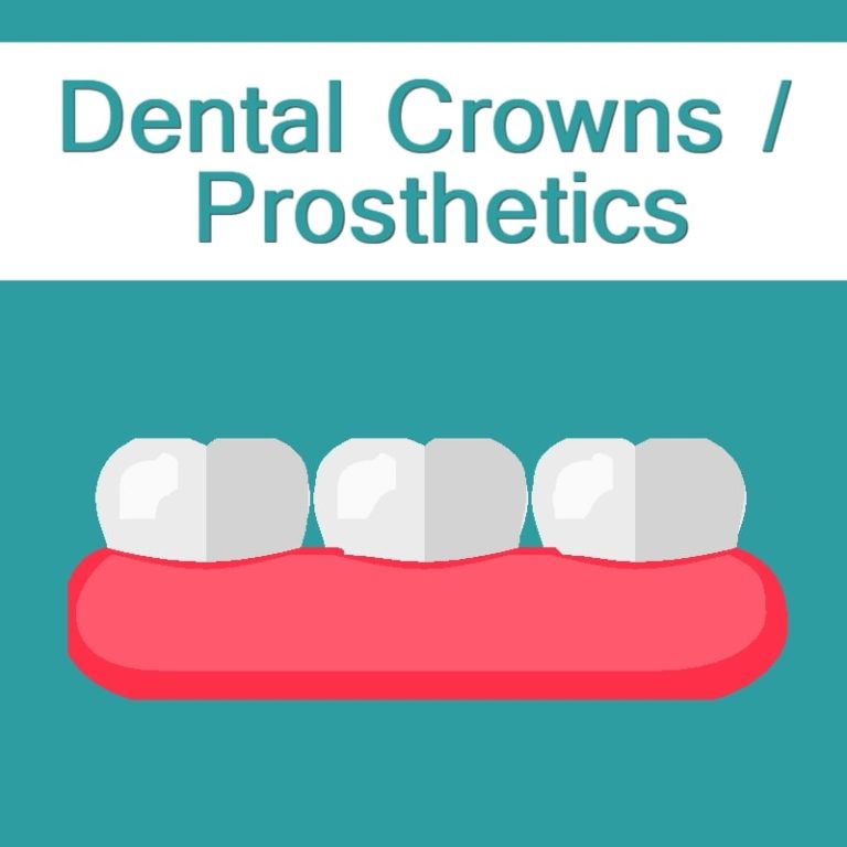 Dental Crowns / Prosthetics Sujay's Dental Care