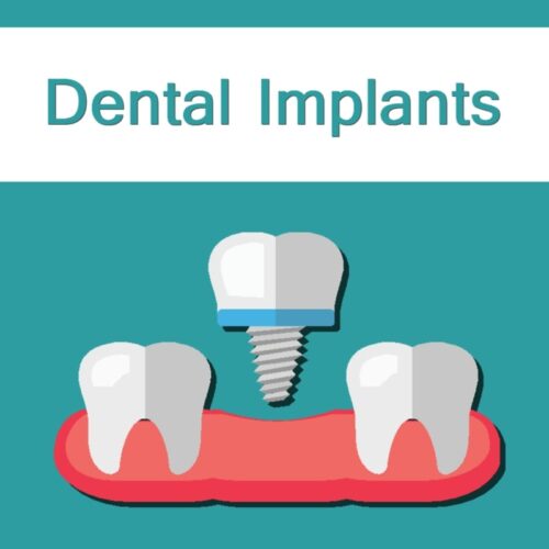 Dental Implants. logo