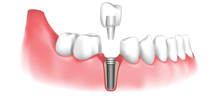 Dental Implant Structure.