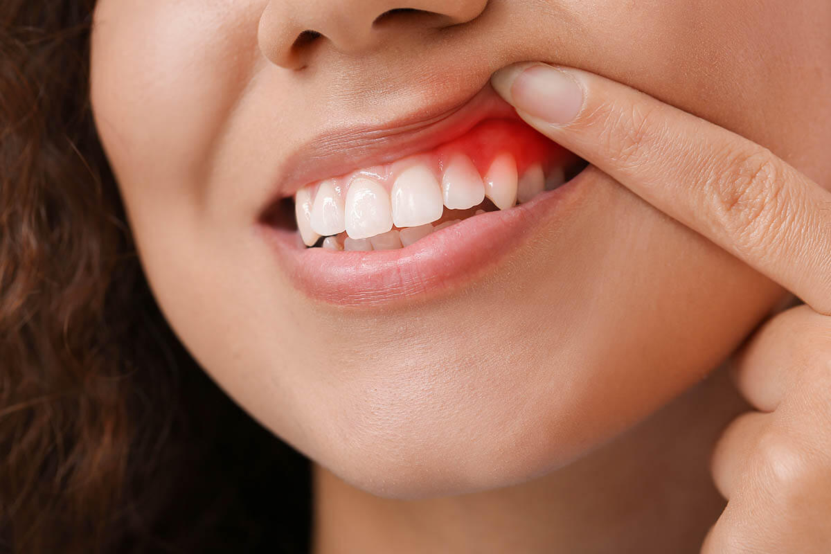 Gingivitis: The Silent Threat to Your Gums — And How to Stop It Early
