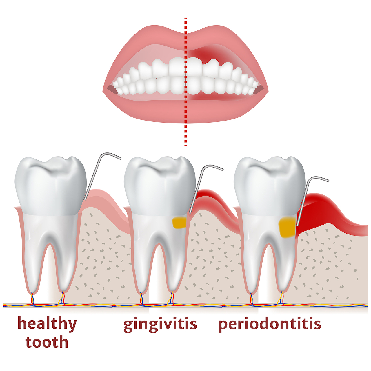 Diagram showing a healthy tooth, gingivitis and periodontitis