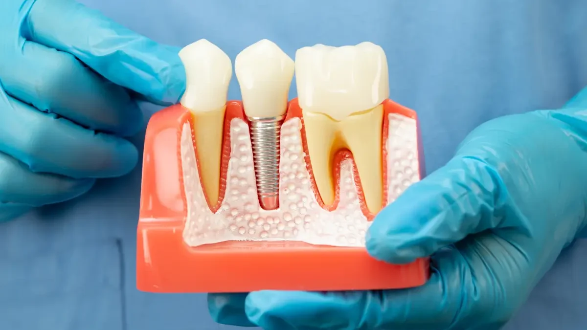 Banashankari’s Guide to Dental Implants: What to Expect Before, During, and After
