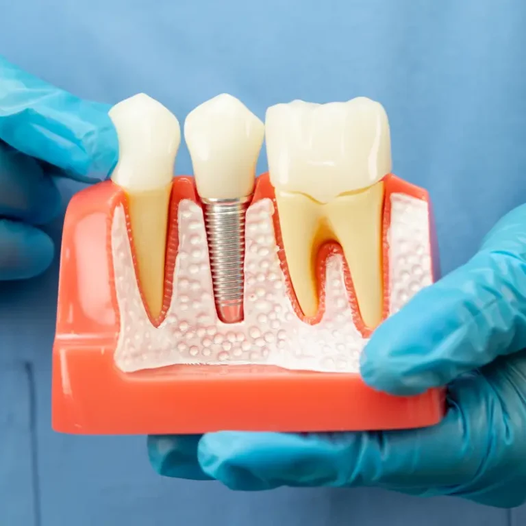 Banashankari’s Guide to Dental Implants: What to Expect Before, During, and After