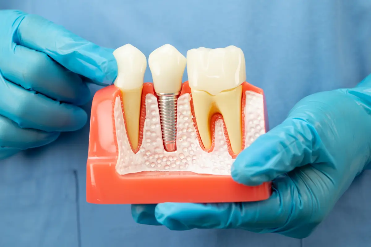 Banashankari’s Guide to Dental Implants: What to Expect Before, During, and After