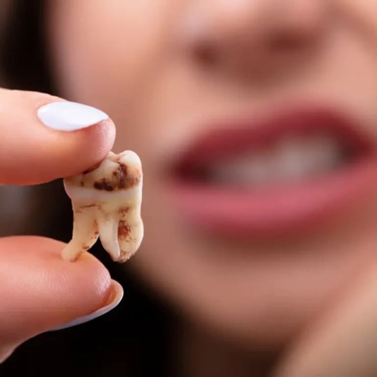 Can a Small Cavity Heal on Its Own? The Truth About Early Tooth Decay