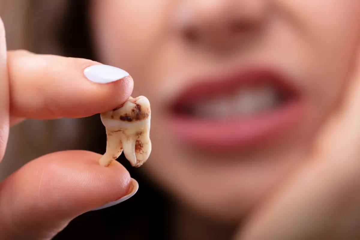 Can a Small Cavity Heal on Its Own? The Truth About Early Tooth Decay
