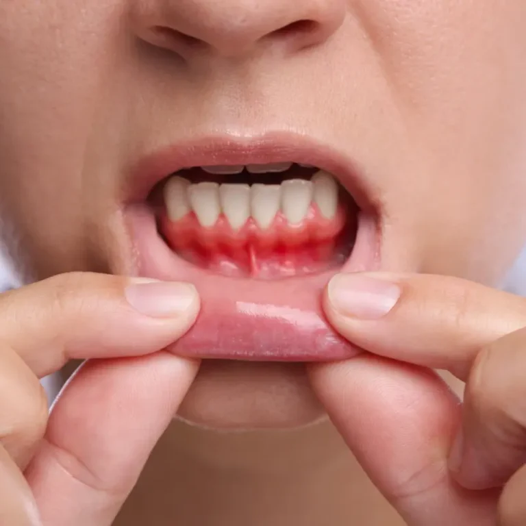 Is Gum Bleeding Normal? What It Really Means and When to See a Dentist