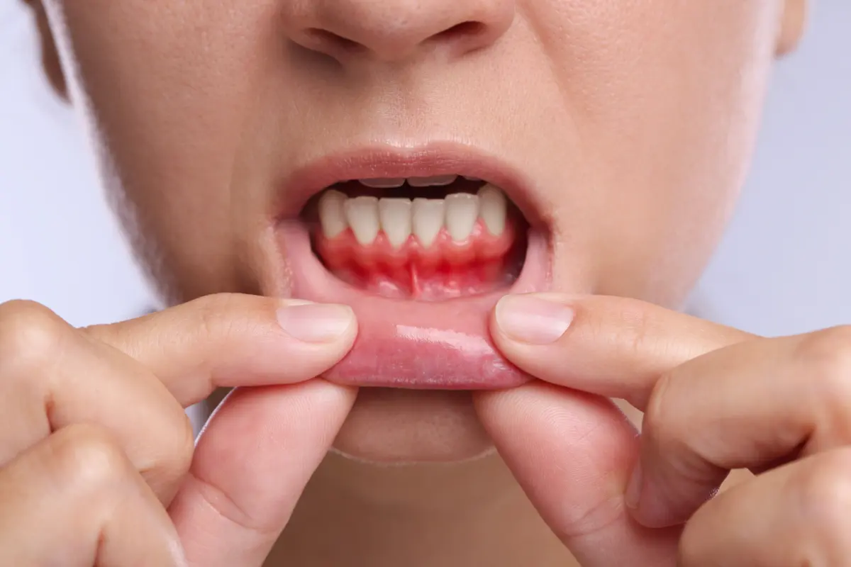 Is Gum Bleeding Normal? What It Really Means and When to See a Dentist